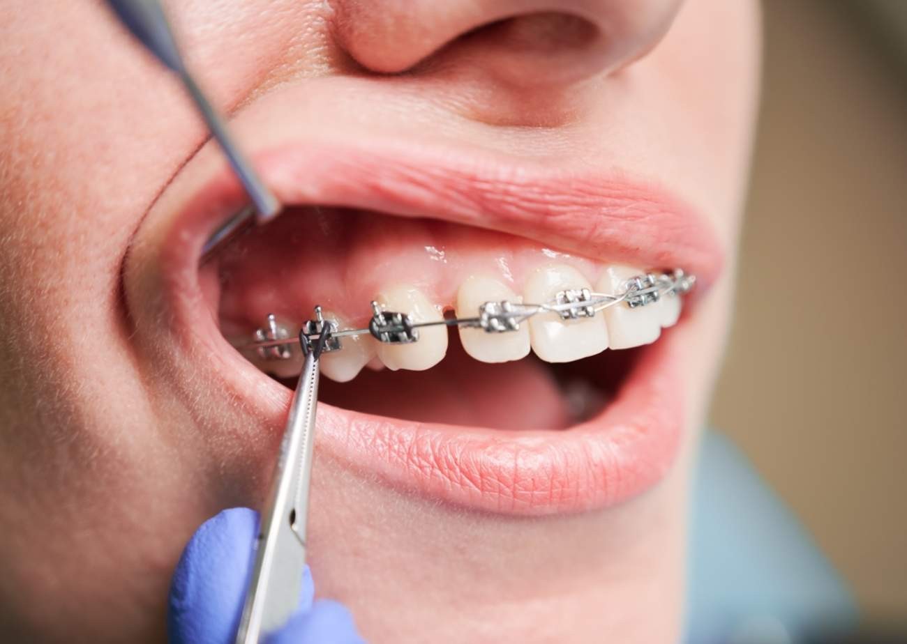 b-el%20irrigador%20bucal%20waterpik%20es%203x%20m%C3%A1s%20eficaz%20que%20el%20hilo%20dental%20para%20pacientes%20ortodonticos.jpg