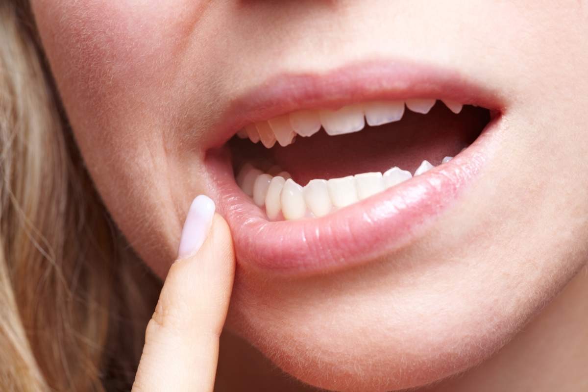 b-gingivitis.jpg