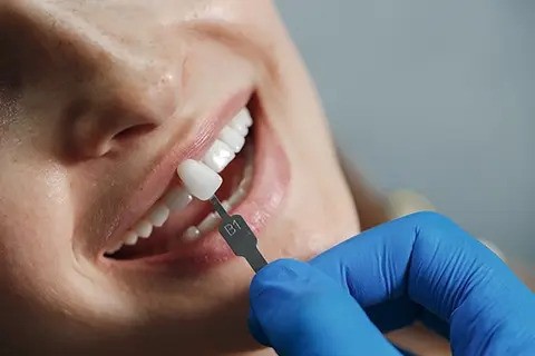 t-cuidado-carillas-dentales.jpg
